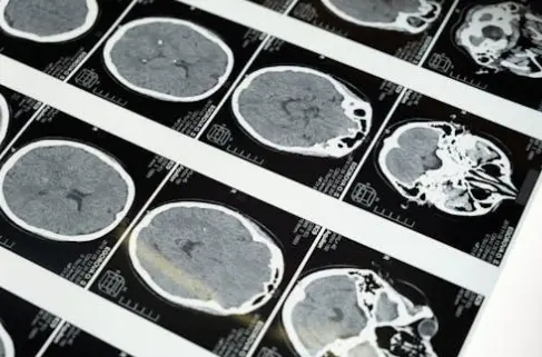 Imágenes de una Resonancia Magnética del cerebro