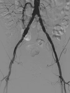 Imagen de una arteriografía mostrando las arterias principales en detalle