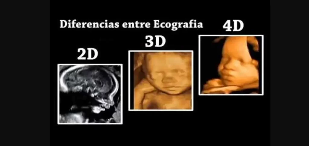 Diferencias entre ecografía 2D, 3D y 4D