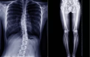 Radiografías panorámicas de columna y extremidades inferiores