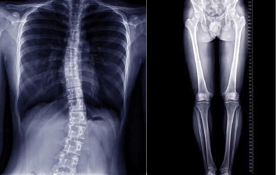 Radiografías panorámicas de columna y extremidades inferiores