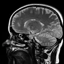 Imagen de una resonancia magnética del cerebro mostrando un corte sagital detallado