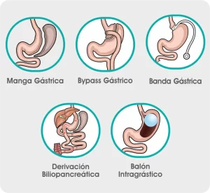 Ilustraciones de diferentes tipos de cirugía bariátrica: manga gástrica, bypass gástrico, banda gástrica, derivación biliopancreática y balón intragástrico