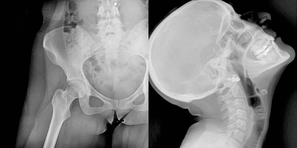 Radiografías dinámicas de la pelvis y el cráneo