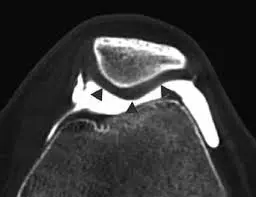 Imagen de Artrotomografía / ArtroTAC de rodilla