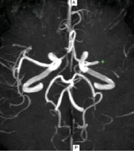 Imagen de angio resonancia cerebral