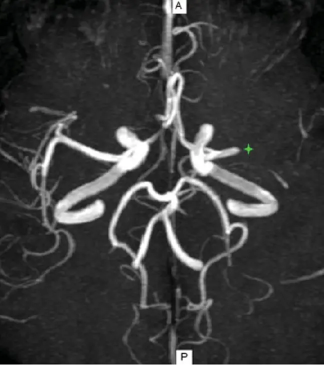 Imagen de angioresonancia cerebral