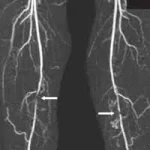 AngioTomografía de los vasos sanguíneos en las piernas