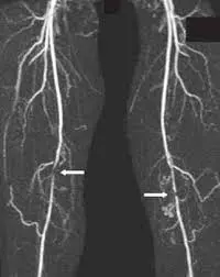 AngioTomografía de los vasos sanguíneos en las piernas