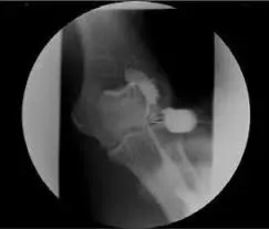 Imagen de Artrografía