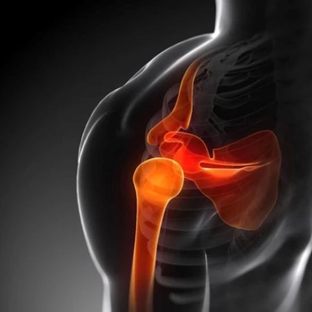 Imagen de ArtroResonancia de la articulación del hombro