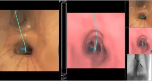 Imágenes de broncoscopia mostrando las vías respiratorias