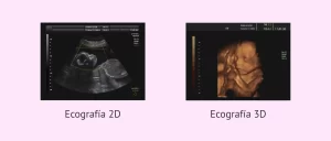 Comparación de ecografía 2D y ecografía 3D
