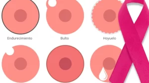 Señales comunes del cáncer de mama, incluyendo endurecimiento, bultos y hoyuelos en el pecho.